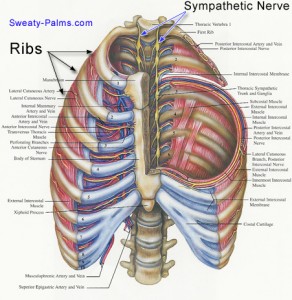 hyperhidrosis_sympathetic