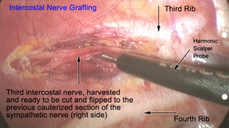 Third intercostal nerve, harvested and ready to be cut and flipped to the previous cauterized section of the sympathetic nerve (right side).