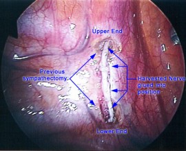 Picture of Reversal for person who previously had the cutting method done