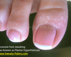 Sweaty Feet: Photo of patient suffering from Excessive Foot Sweating ©2010