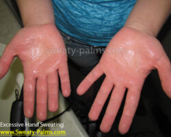 View Gallery Sweaty Hands Photo of patient suffering from Hyperhidrosis (Sweaty Hands/Palms)