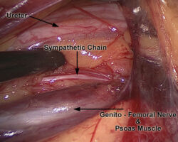 Lumbar Sympathectomy