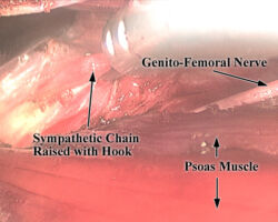 Lumbar Sympathectomy