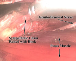Lumbar Sympathectomy