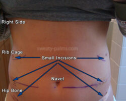 Lumbar Sympathectomy