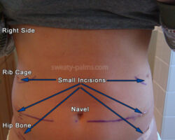 Lumbar Sympathectomy