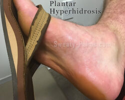 Excessive Foot Sweating