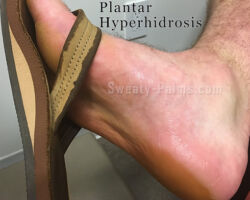 Excessive Foot Sweating